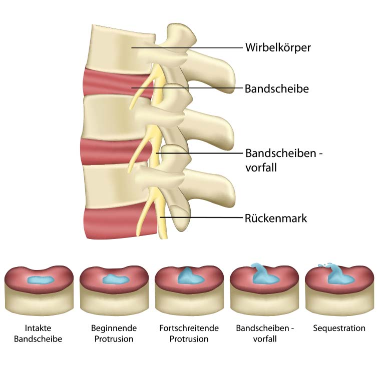 Bandscheibenvorfall