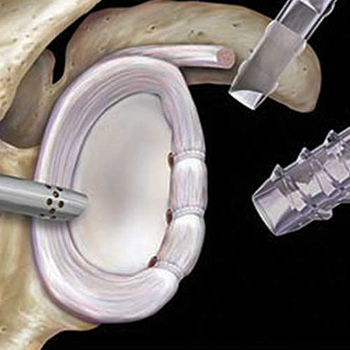 Schulter Sehnenriss - Gelenklippeneinriss